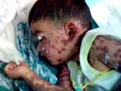 Four year old Ali Ghazi suffers from Steve Johnsons Syndrome (SJS)